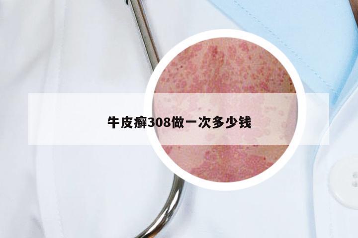 牛皮癣308做一次多少钱