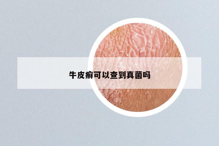 牛皮癣可以查到真菌吗
