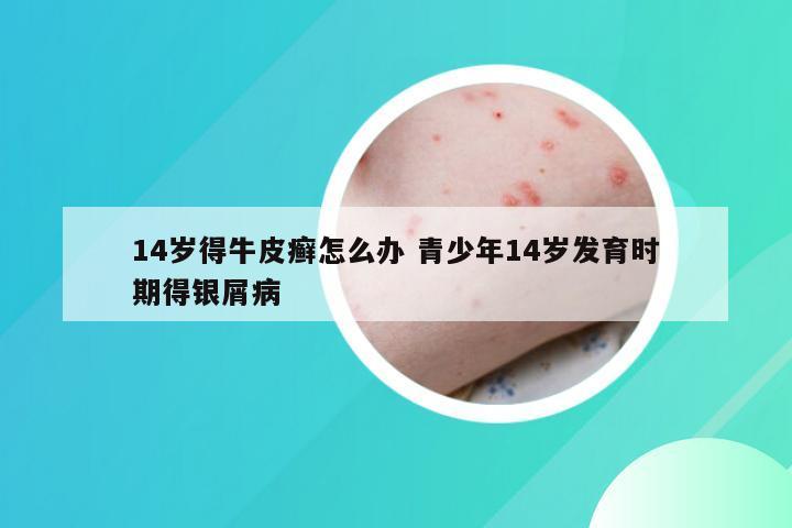 14岁得牛皮癣怎么办 青少年14岁发育时期得银屑病