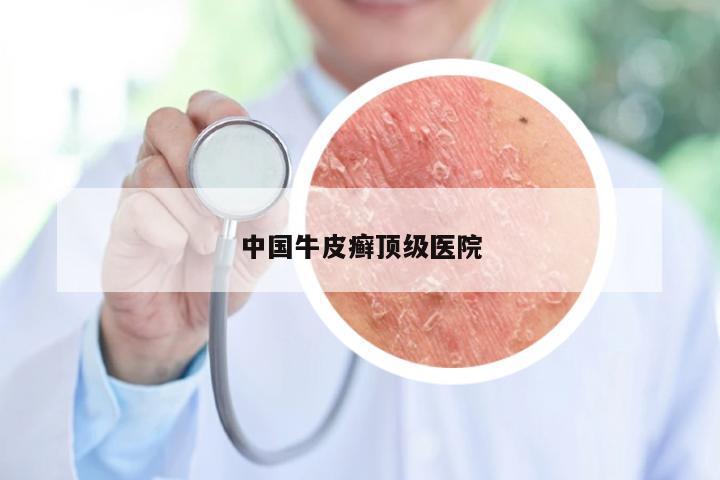 中国牛皮癣顶级医院