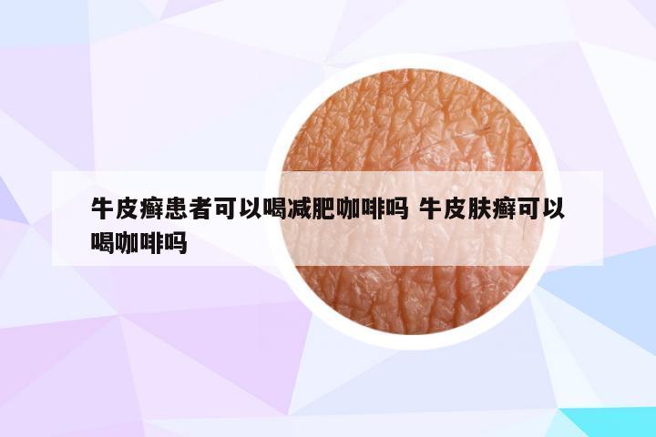 牛皮癣患者可以喝减肥咖啡吗 牛皮肤癣可以喝咖啡吗