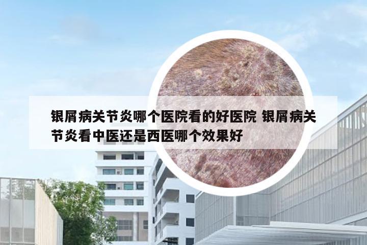 银屑病关节炎哪个医院看的好医院 银屑病关节炎看中医还是西医哪个效果好