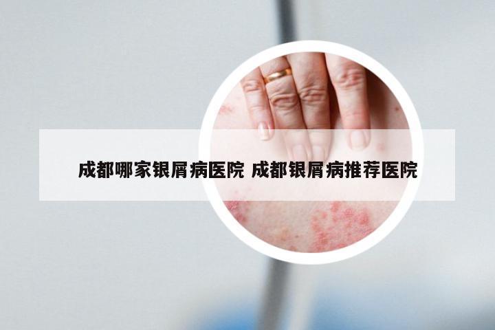 成都哪家银屑病医院 成都银屑病推荐医院
