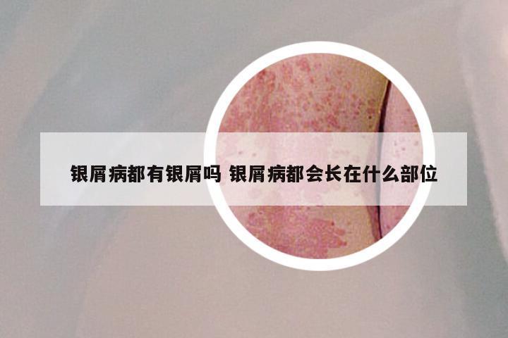 银屑病都有银屑吗 银屑病都会长在什么部位