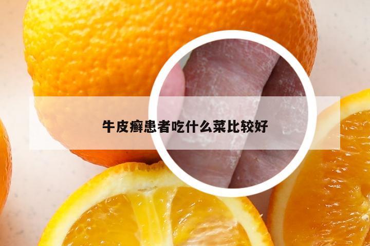 牛皮癣患者吃什么菜比较好
