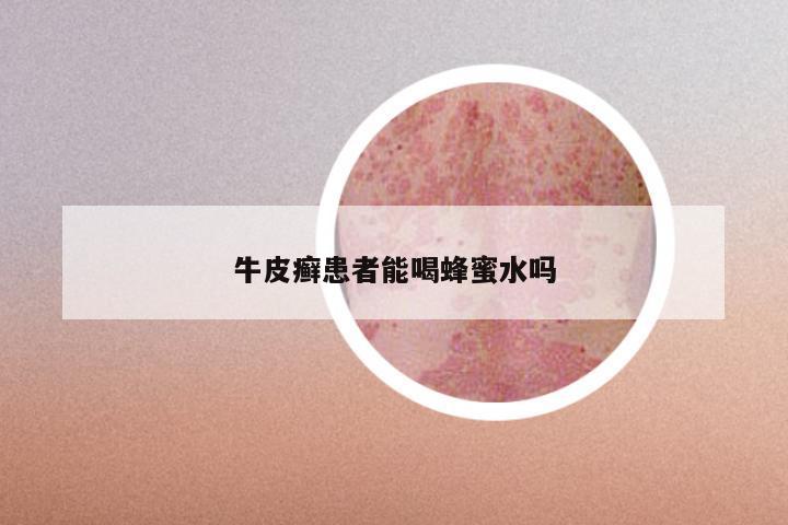 牛皮癣患者能喝蜂蜜水吗