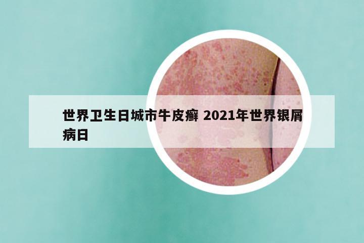 世界卫生日城市牛皮癣 2021年世界银屑病日