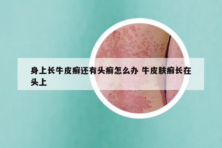 身上长牛皮癣还有头癣怎么办 牛皮肤癣长在头上