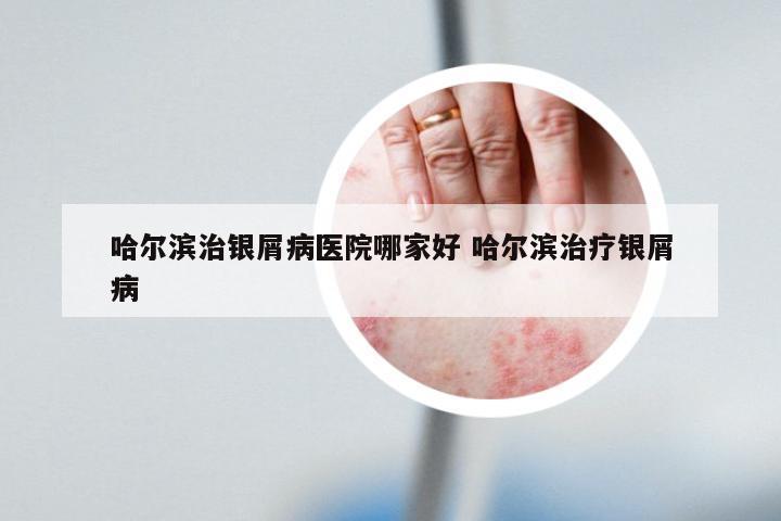 哈尔滨治银屑病医院哪家好 哈尔滨治疗银屑病