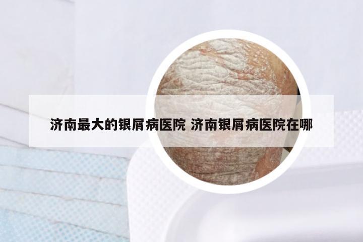 济南最大的银屑病医院 济南银屑病医院在哪