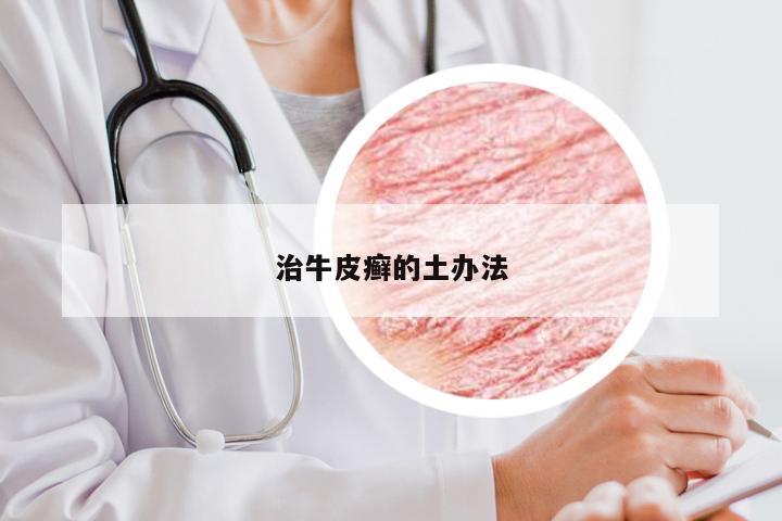 治牛皮癣的土办法
