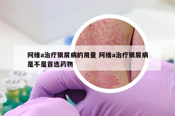 阿维a治疗银屑病的用量 阿维a治疗银屑病是不是首选药物