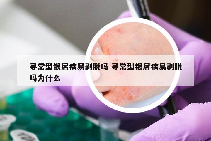 寻常型银屑病易剥脱吗 寻常型银屑病易剥脱吗为什么