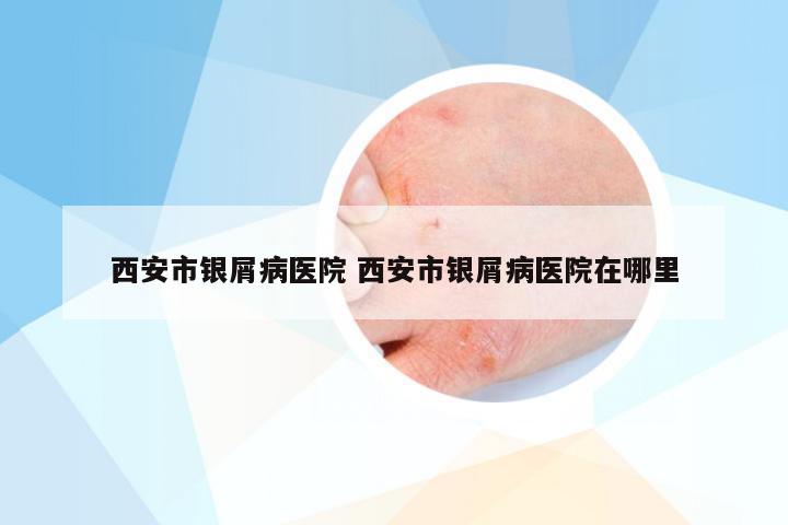 西安市银屑病医院 西安市银屑病医院在哪里