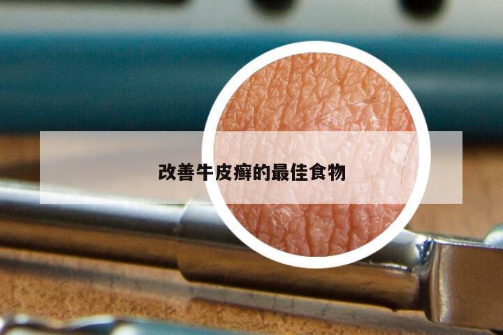 改善牛皮癣的最佳食物