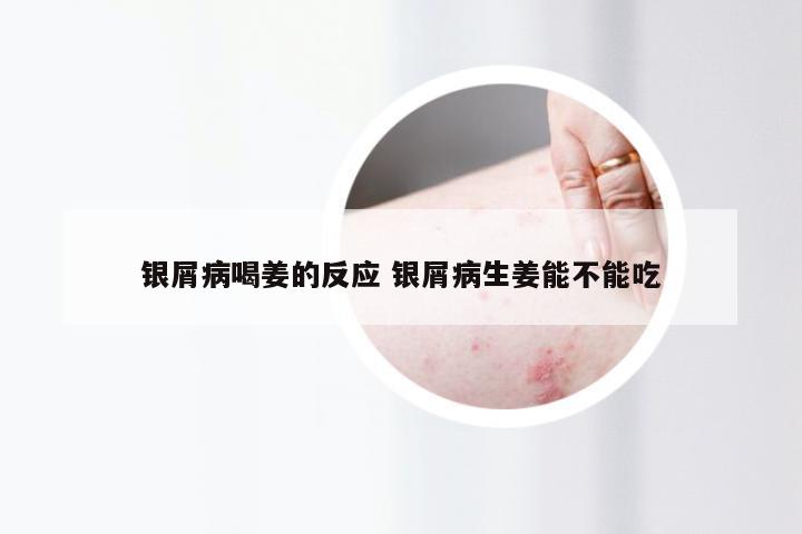 银屑病喝姜的反应 银屑病生姜能不能吃