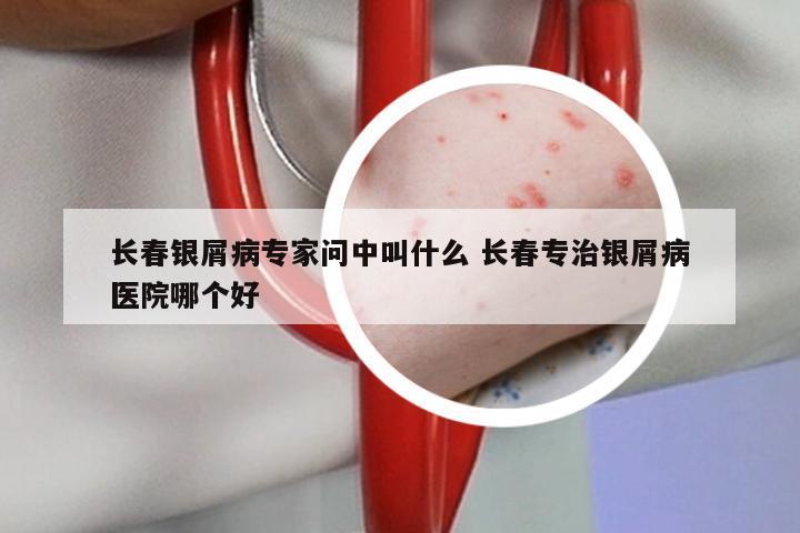长春银屑病专家问中叫什么 长春专治银屑病医院哪个好