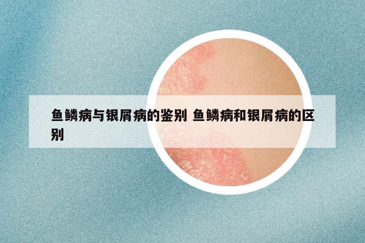 鱼鳞病与银屑病的鉴别 鱼鳞病和银屑病的区别