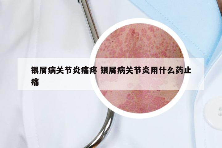 银屑病关节炎痛疼 银屑病关节炎用什么药止痛