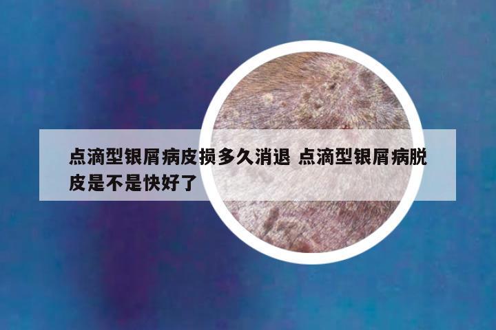 点滴型银屑病皮损多久消退 点滴型银屑病脱皮是不是快好了