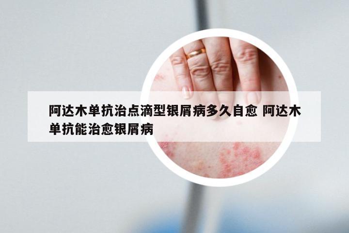 阿达木单抗治点滴型银屑病多久自愈 阿达木单抗能治愈银屑病