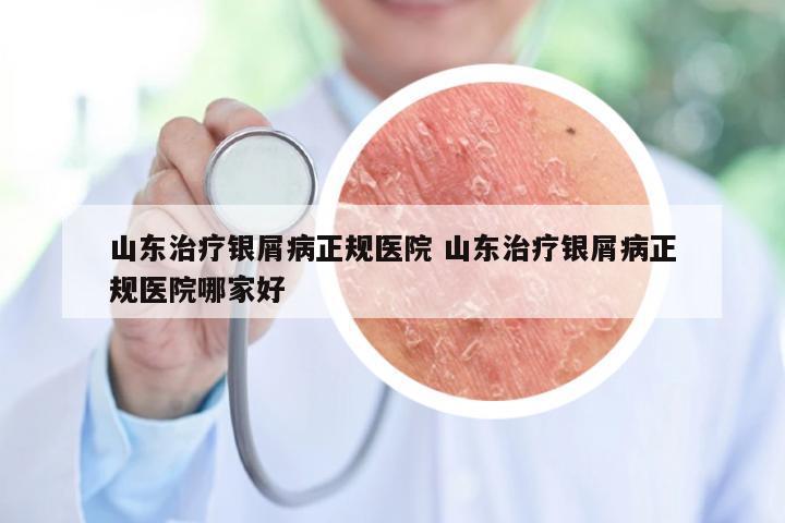 山东治疗银屑病正规医院 山东治疗银屑病正规医院哪家好