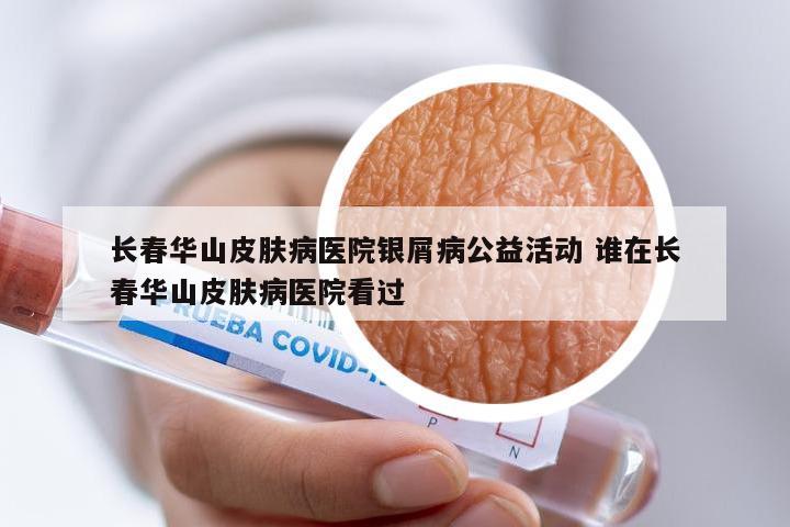 长春华山皮肤病医院银屑病公益活动 谁在长春华山皮肤病医院看过