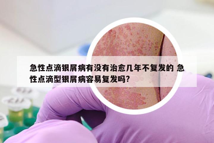 急性点滴银屑病有没有治愈几年不复发的 急性点滴型银屑病容易复发吗?