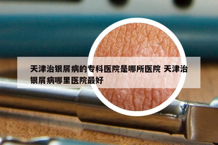 天津治银屑病的专科医院是哪所医院 天津治银屑病哪里医院最好