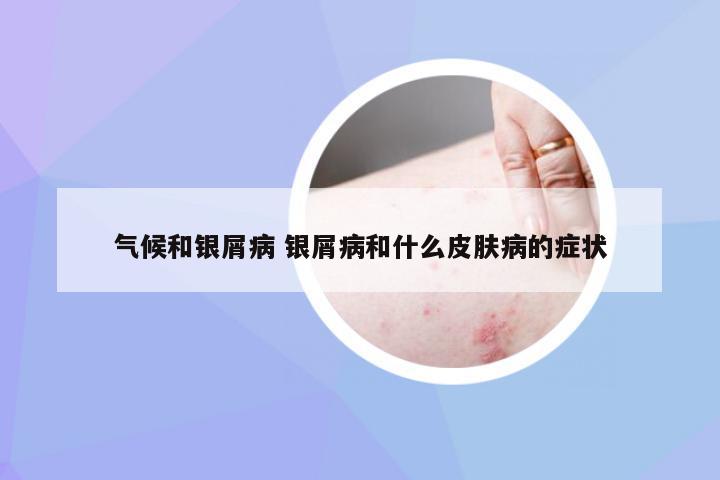 气候和银屑病 银屑病和什么皮肤病的症状