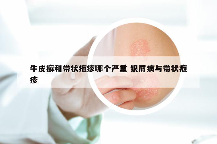 牛皮癣和带状疱疹哪个严重 银屑病与带状疱疹