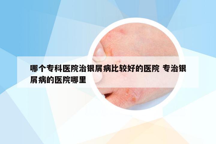 哪个专科医院治银屑病比较好的医院 专治银屑病的医院哪里