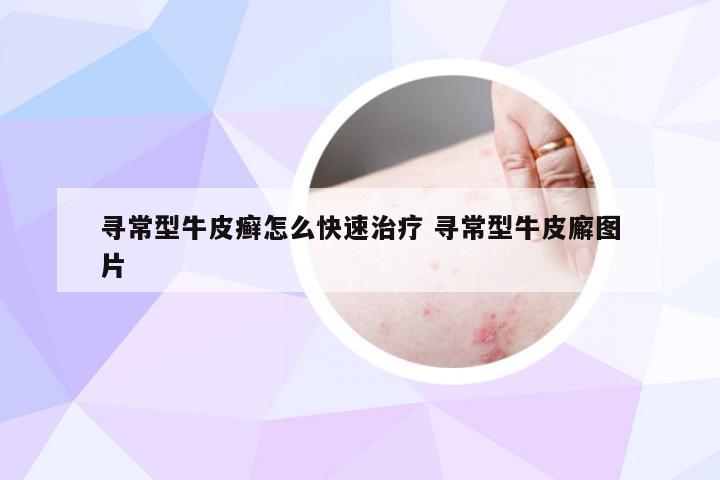 寻常型牛皮癣怎么快速治疗 寻常型牛皮廨图片