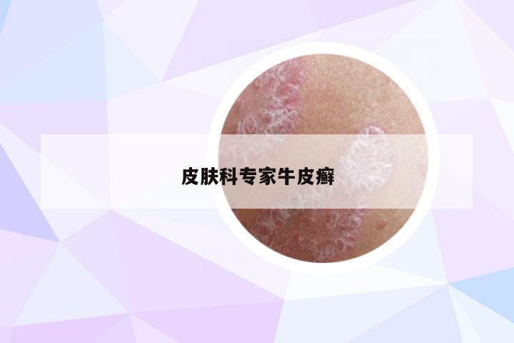 皮肤科专家牛皮癣
