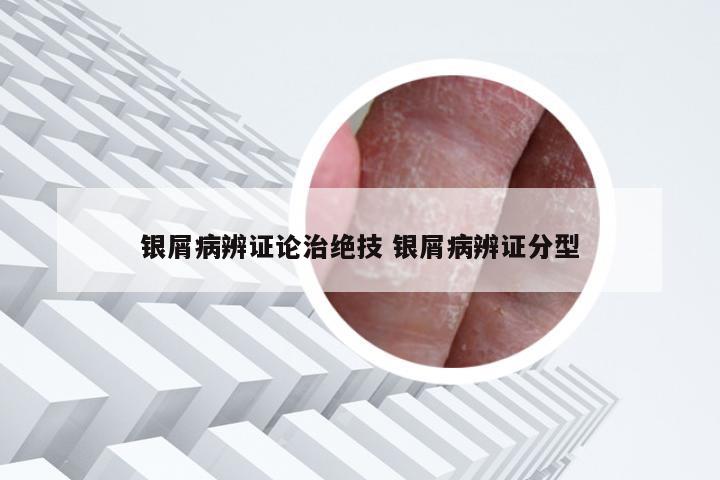 银屑病辨证论治绝技 银屑病辨证分型