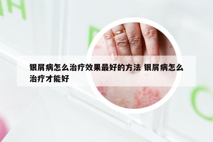 银屑病怎么治疗效果最好的方法 银屑病怎么治疗才能好