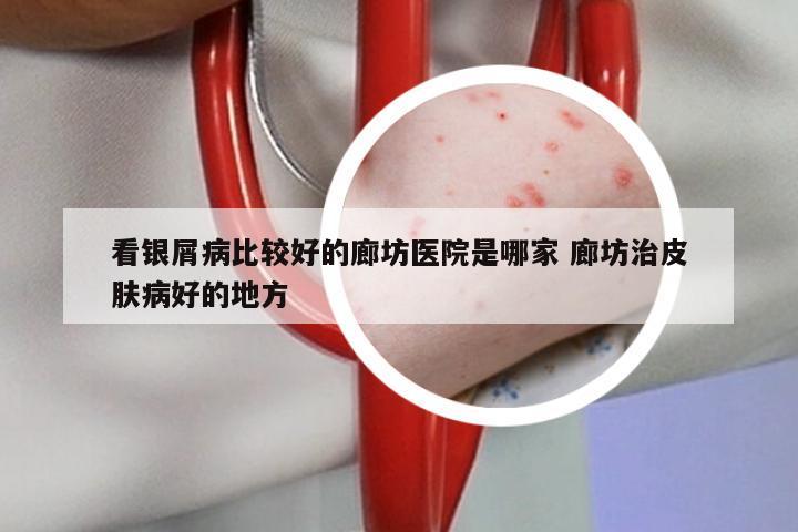 看银屑病比较好的廊坊医院是哪家 廊坊治皮肤病好的地方