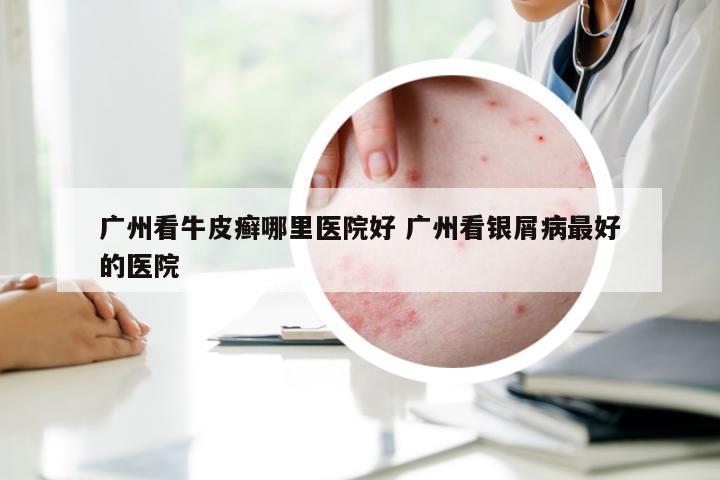广州看牛皮癣哪里医院好 广州看银屑病最好的医院