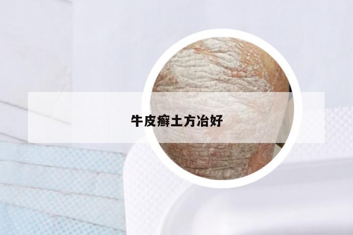 牛皮癣土方冶好
