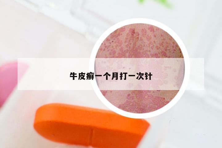 牛皮癣一个月打一次针