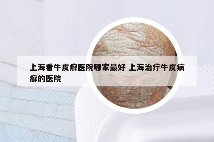 上海看牛皮癣医院哪家最好 上海治疗牛皮病癣的医院