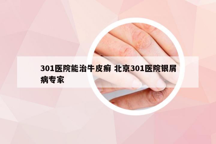 301医院能治牛皮癣 北京301医院银屑病专家