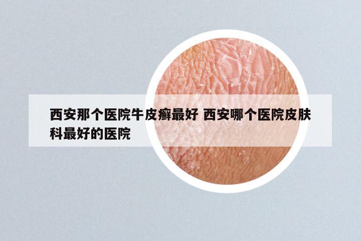 西安那个医院牛皮癣最好 西安哪个医院皮肤科最好的医院