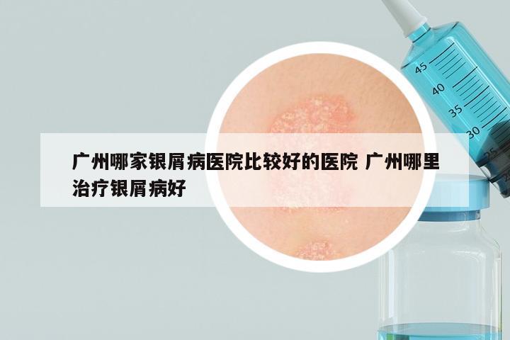 广州哪家银屑病医院比较好的医院 广州哪里治疗银屑病好
