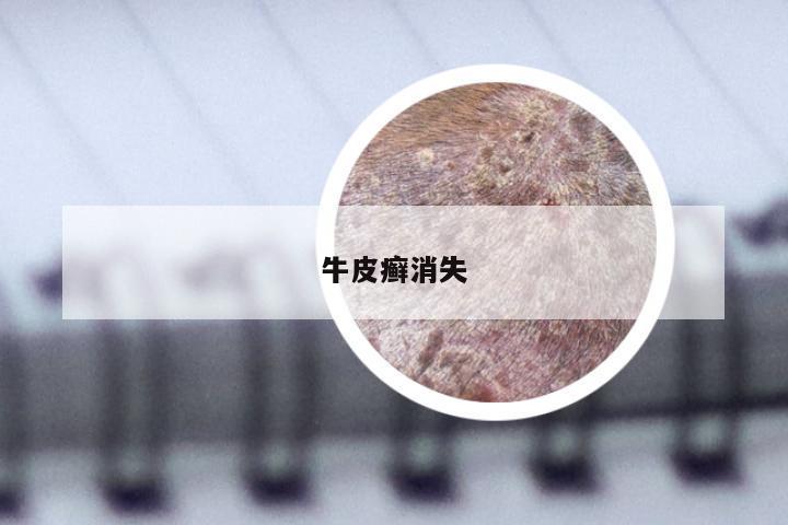 牛皮癣消失