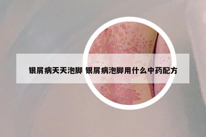 银屑病天天泡脚 银屑病泡脚用什么中药配方