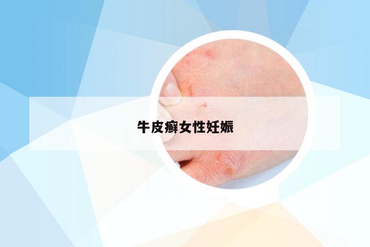牛皮癣女性妊娠