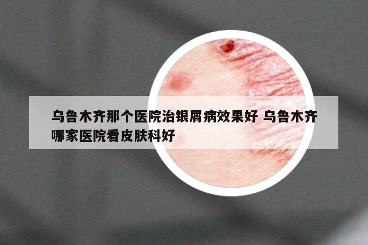 乌鲁木齐那个医院治银屑病效果好 乌鲁木齐哪家医院看皮肤科好