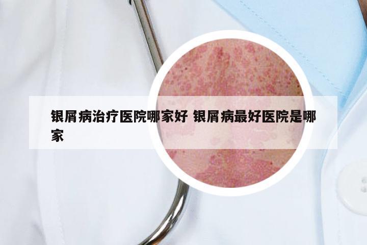 银屑病治疗医院哪家好 银屑病最好医院是哪家
