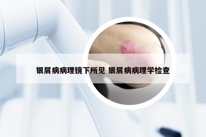 银屑病病理镜下所见 银屑病病理学检查